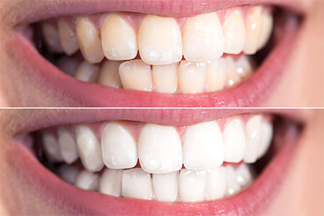 五反田　歯医者　ホワイトニング比較