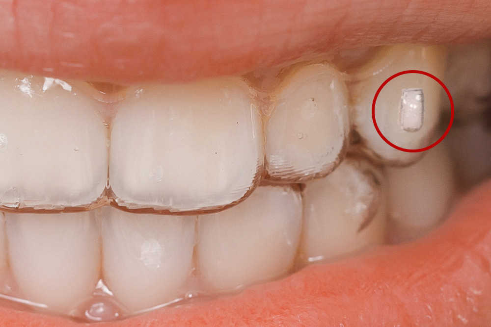 インビザラインアタッチメント