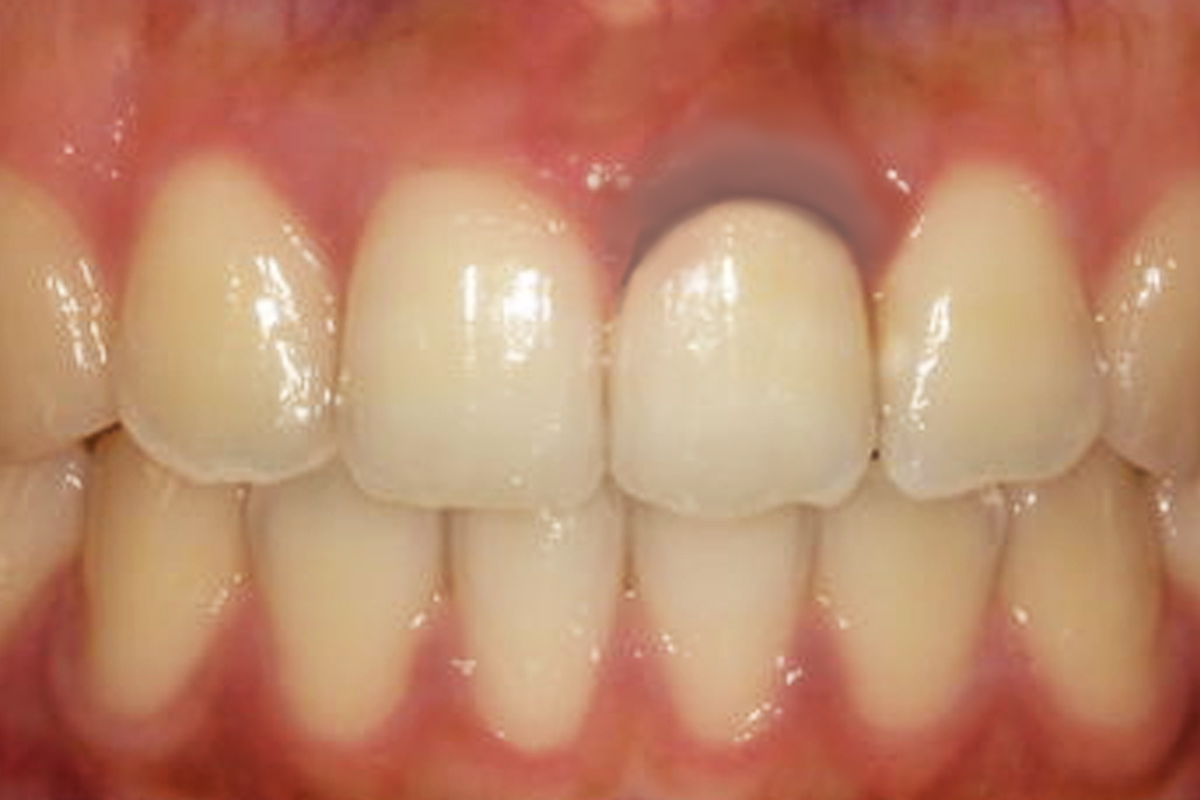 メタルタトゥー（歯ぐきの黒ずみ）を除去